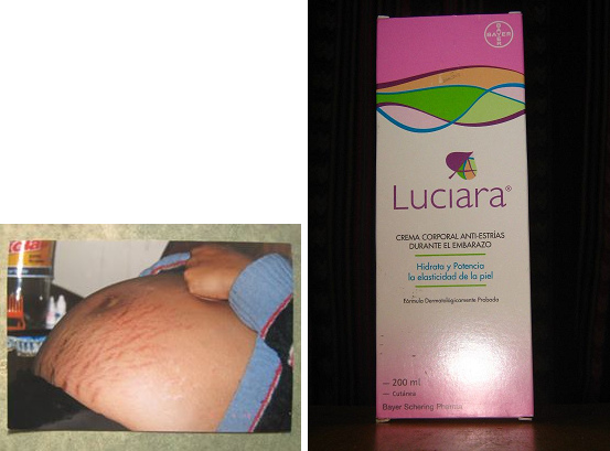 Una mujer embarazada con estrillas sin crema - y
              aqu est la crema Luciara con efecto contra estrillas.